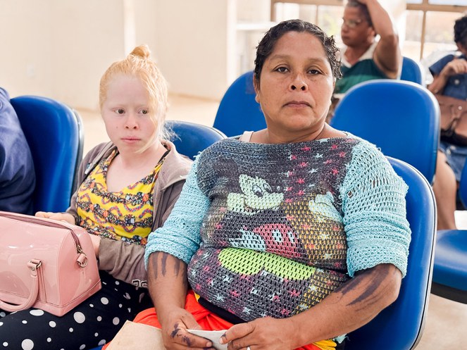 Edite Krahô e uma de suas filhas gêmeas, que têm albinismo. Foto: Roneymar Alves.